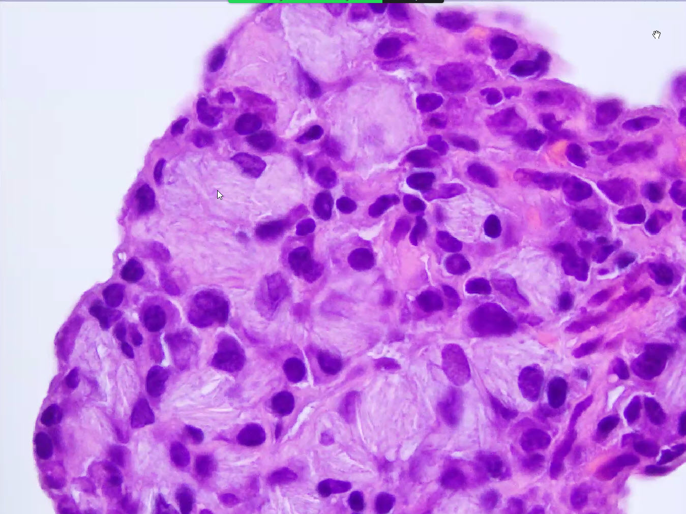 Crystal storing histiocytosis KiKo XP